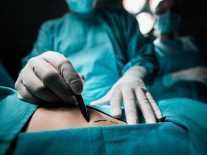 image-close-up-of-a-plastic-surgeon-marking-the-human-skin-for-surgery