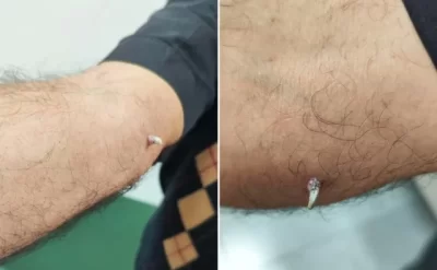 Dəri xərçəngi belə ortaya çıxdı: