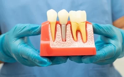 Ölü heyvan və insan sümüyündən hazırlanan diş implantları