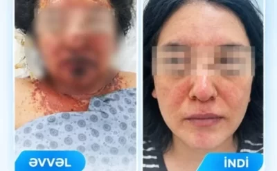 Dərman qəbulundan sonra ağır allergik reaksiya verdi -