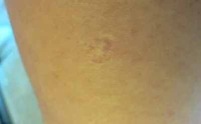 Uşaqlıqda vurulan peyvənd qolda niyə dairəvi iz buraxır?