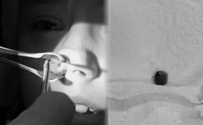 Başı ağrıdı, həkimə getdi, səbəbi burnundan tapıldı
